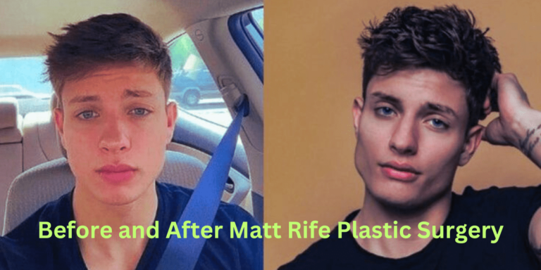 Before-and-After-Matt-Rife-Plastic-Surgery