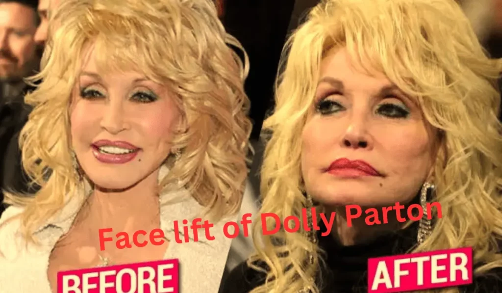 Face lift of Dolly Parton